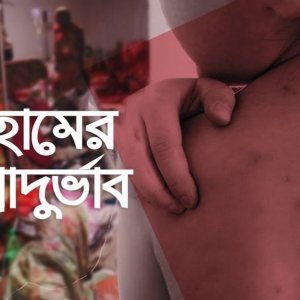 থামছেই হামের দাপট, একদিনে ঝরলো আরও ৪ প্রাণ